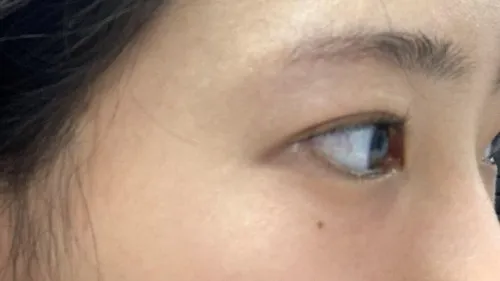 Incisional Double Eyelid Surgery, Ptosis Correction — RE&RE PLASTIC SURGERY 4