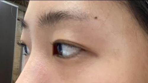 Incisional Double Eyelid Surgery, Ptosis Correction — RE&RE PLASTIC SURGERY 5