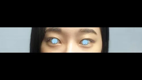 Natural Adhesion Double Eyelid Surgery — RE&RE PLASTIC SURGERY 2