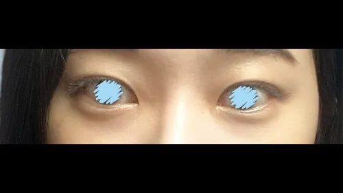 Natural Adhesion Double Eyelid Surgery — RE&RE PLASTIC SURGERY 3
