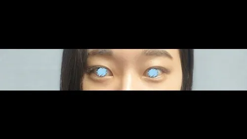 Natural Adhesion Double Eyelid Surgery — RE&RE PLASTIC SURGERY 4