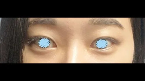 Natural Adhesion Double Eyelid Surgery — RE&RE PLASTIC SURGERY 5
