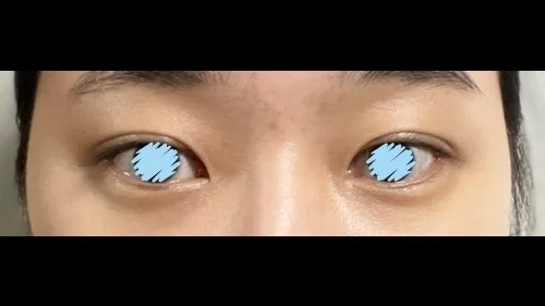Natural Adhesion Double Eyelid Surgery — RE&RE PLASTIC SURGERY 6