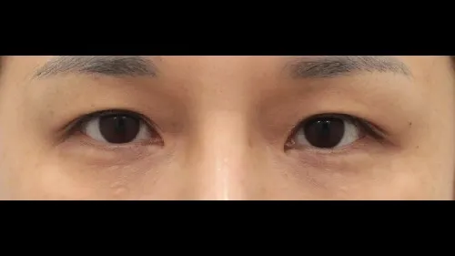 Natural Adhesion Double Eyelid Surgery — RE&RE PLASTIC SURGERY 1