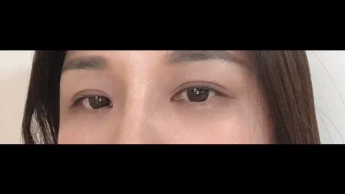 Natural Adhesion Double Eyelid Surgery — RE&RE PLASTIC SURGERY 2