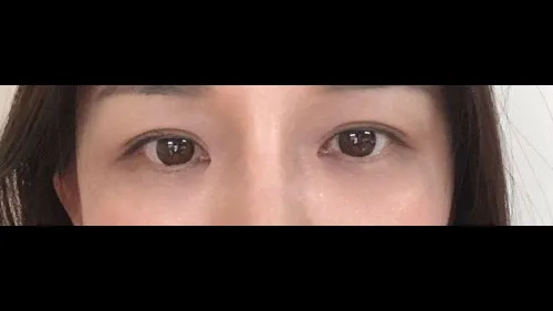 Natural Adhesion Double Eyelid Surgery — RE&RE PLASTIC SURGERY 3