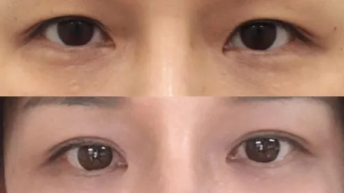 Natural Adhesion Double Eyelid Surgery — RE&RE PLASTIC SURGERY 5