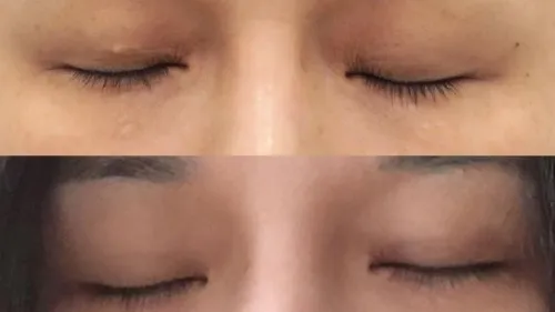 Natural Adhesion Double Eyelid Surgery — RE&RE PLASTIC SURGERY 6