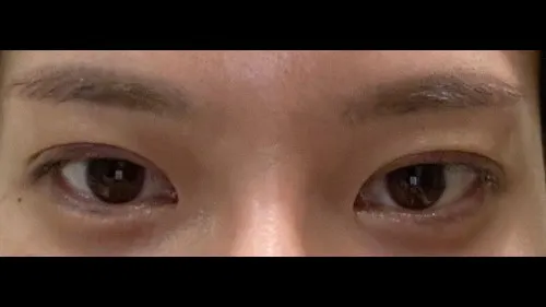 Incisional Double Eyelid Surgery — RE&RE PLASTIC SURGERY 2