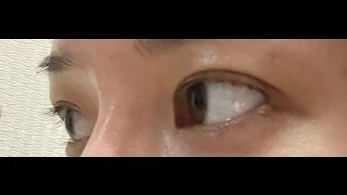 Incisional Double Eyelid Surgery — RE&RE PLASTIC SURGERY 3