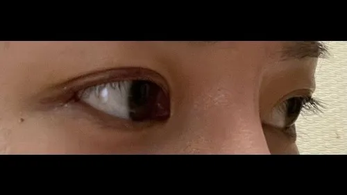 Incisional Double Eyelid Surgery — RE&RE PLASTIC SURGERY 4
