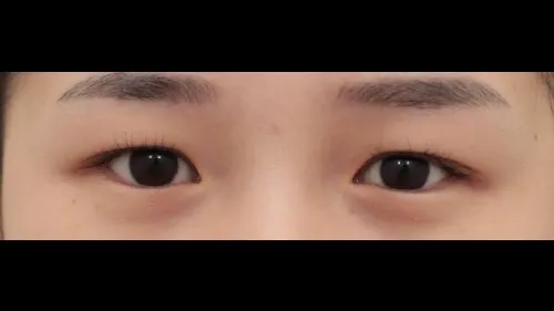 Partial Incision Double Eyelid Surgery 1