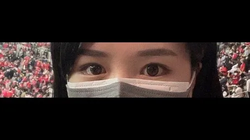 Partial Incision Double Eyelid Surgery 2