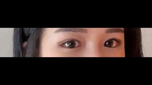 Partial Incision Double Eyelid Surgery — RE&RE PLASTIC SURGERY 4
