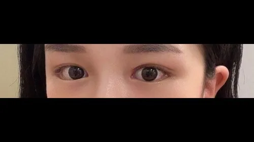 Partial Incision Double Eyelid Surgery — RE&RE PLASTIC SURGERY 5