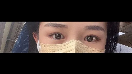 Partial Incision Double Eyelid Surgery — RE&RE PLASTIC SURGERY 6