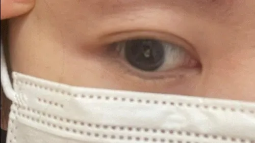 Incisional Double Eyelid Surgery — RE&RE PLASTIC SURGERY 2