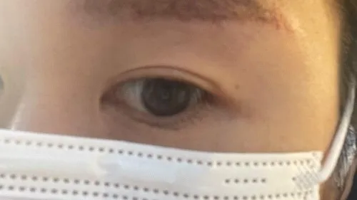 Incisional Double Eyelid Surgery — RE&RE PLASTIC SURGERY 3