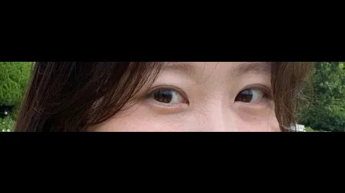 Incisional Double Eyelid Surgery — RE&RE PLASTIC SURGERY 4