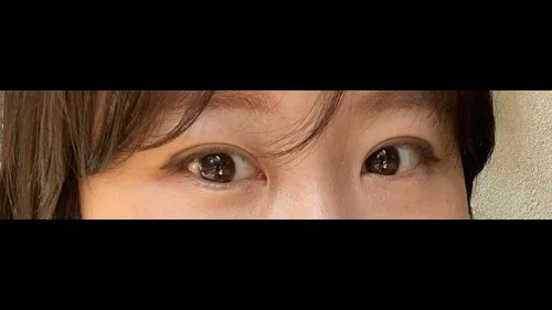 Incisional Double Eyelid Surgery — RE&RE PLASTIC SURGERY 5