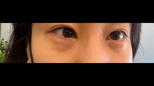 眼底脂肪重排, 眼底脂肪填充 1