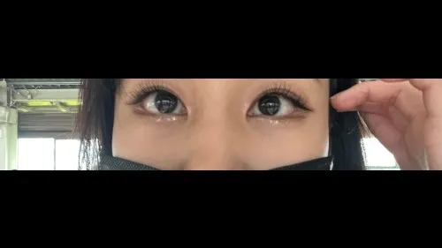 目の下脂肪再配置, 目の下脂肪移植 — RE&RE PLASTIC SURGERY 2