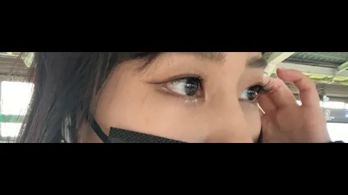 目の下脂肪再配置, 目の下脂肪移植 — RE&RE PLASTIC SURGERY 3