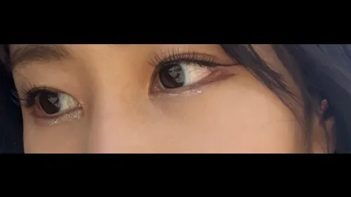 目の下脂肪再配置, 目の下脂肪移植 — RE&RE PLASTIC SURGERY 4