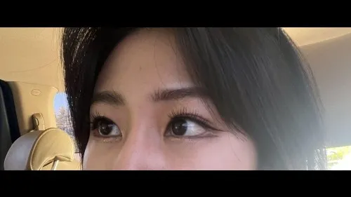 目の下脂肪再配置, 目の下脂肪移植 — RE&RE PLASTIC SURGERY 5