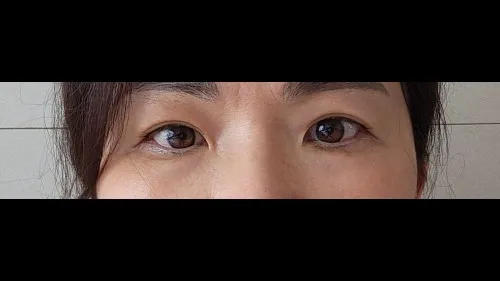 Sub-brow Lift — RE&RE PLASTIC SURGERY 2