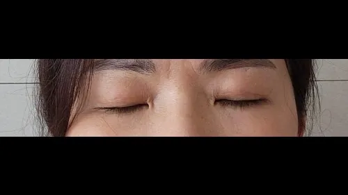 Sub-brow Lift — RE&RE PLASTIC SURGERY 3