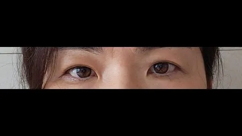 Sub-brow Lift — RE&RE PLASTIC SURGERY 4