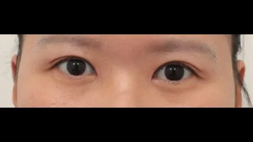 Incisional Double Eyelid Surgery, Ptosis Correction — RE&RE PLASTIC SURGERY 2