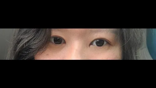 Incisional Double Eyelid Surgery, Ptosis Correction — RE&RE PLASTIC SURGERY 3