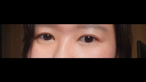 Incisional Double Eyelid Surgery, Ptosis Correction — RE&RE PLASTIC SURGERY 4