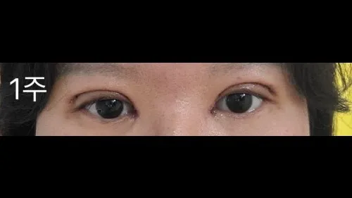 Incisional Double Eyelid Surgery, Ptosis Correction — RE&RE PLASTIC SURGERY 5