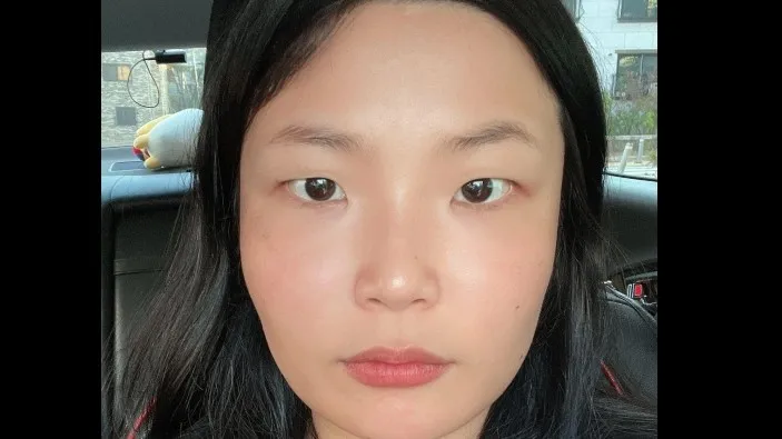 Incisional Double Eyelid Surgery, Ptosis Correction — RE&RE PLASTIC SURGERY 2