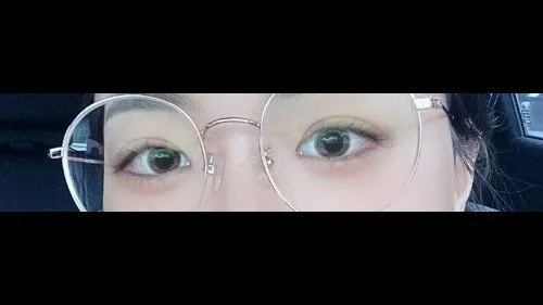 Incisional Double Eyelid Surgery — RE&RE PLASTIC SURGERY 2