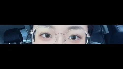 Incisional Double Eyelid Surgery — RE&RE PLASTIC SURGERY 4
