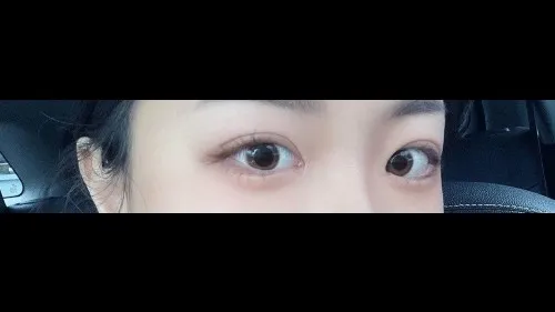 Incisional Double Eyelid Surgery — RE&RE PLASTIC SURGERY 5