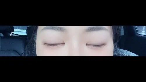 Incisional Double Eyelid Surgery — RE&RE PLASTIC SURGERY 6