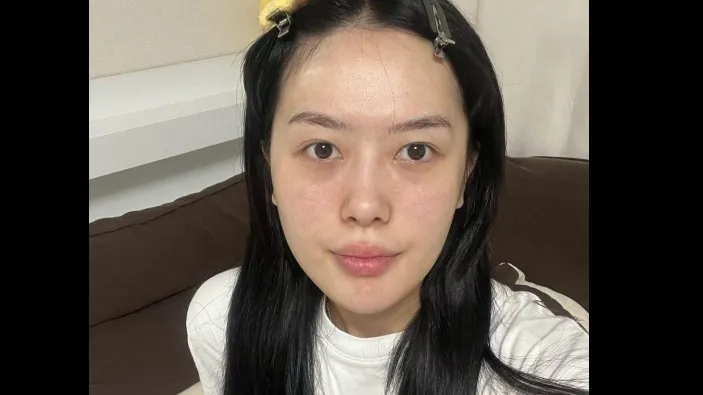 Incisional Double Eyelid Surgery, Ptosis Correction, Lower Eyelid Fat Repositioning, Lower Eyelid Fat Grafting, Facial Fat Grafting — RE&RE PLASTIC SURGERY 1