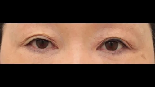 Sub-brow Lift, Ptosis Correction, Lower Eyelid Fat Grafting — RE&RE PLASTIC SURGERY 1