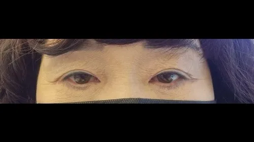 Sub-brow Lift, Ptosis Correction, Lower Eyelid Fat Grafting — RE&RE PLASTIC SURGERY 2