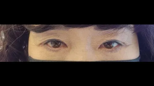 Sub-brow Lift, Ptosis Correction, Lower Eyelid Fat Grafting — RE&RE PLASTIC SURGERY 3