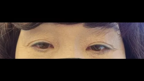 Sub-brow Lift, Ptosis Correction, Lower Eyelid Fat Grafting — RE&RE PLASTIC SURGERY 4
