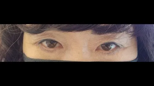 Sub-brow Lift, Ptosis Correction, Lower Eyelid Fat Grafting — RE&RE PLASTIC SURGERY 5