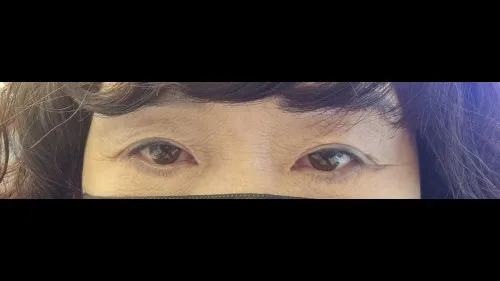 Sub-brow Lift, Ptosis Correction, Lower Eyelid Fat Grafting — RE&RE PLASTIC SURGERY 6