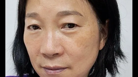 Sub-brow Lift, Lower Blepharoplasty (Aging Eye Rejuvenation), Midface Lift — RE&RE PLASTIC SURGERY 1