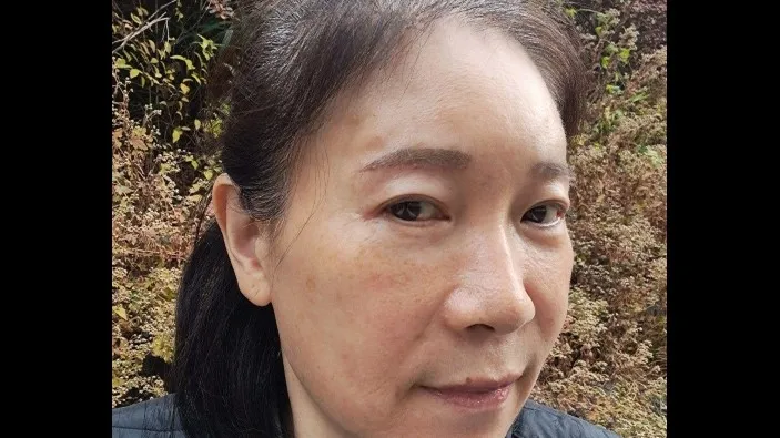 Sub-brow Lift, Lower Blepharoplasty (Aging Eye Rejuvenation), Midface Lift — RE&RE PLASTIC SURGERY 2
